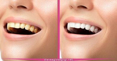 Evde Sarı Diş Beyazlatma Yöntemleri, evde sarı diş beyazlatma, sarı diş beyazlatma, hızlıca sarı diş beyazlatma,